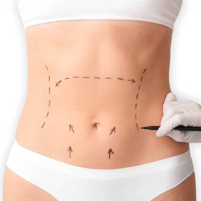 Abdominoplasty