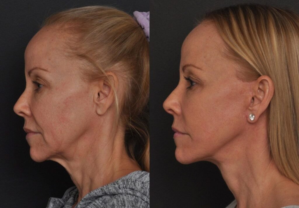 Facelift neck lift