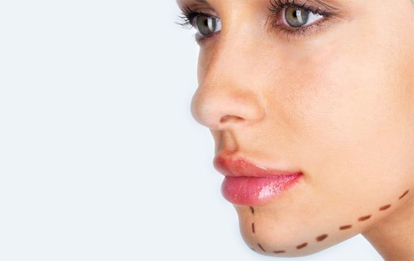 Implantschin cheek buttocks2