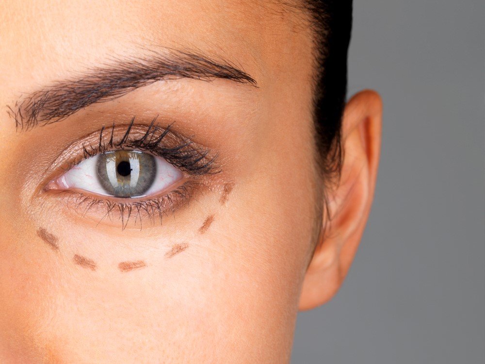 blepharoplasty dubai1
