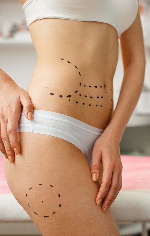 female patient with markers on her abdomen botox DK7QYBP