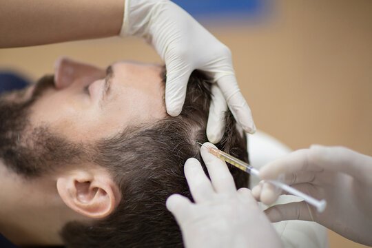 What Should You Expect During a Scalp Mesotherapy Treatment in Dubai? 2 Mesotherapy in Dubai