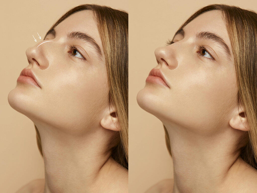 What factors determine the Rhinoplasty Cost in Uae? 2 Rhinoplasty in uae